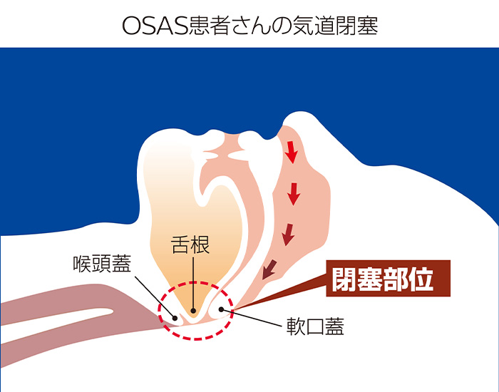 OSAS患者さんの気道閉塞