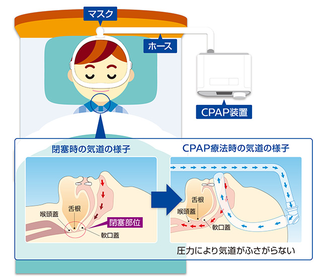 CPAP療法